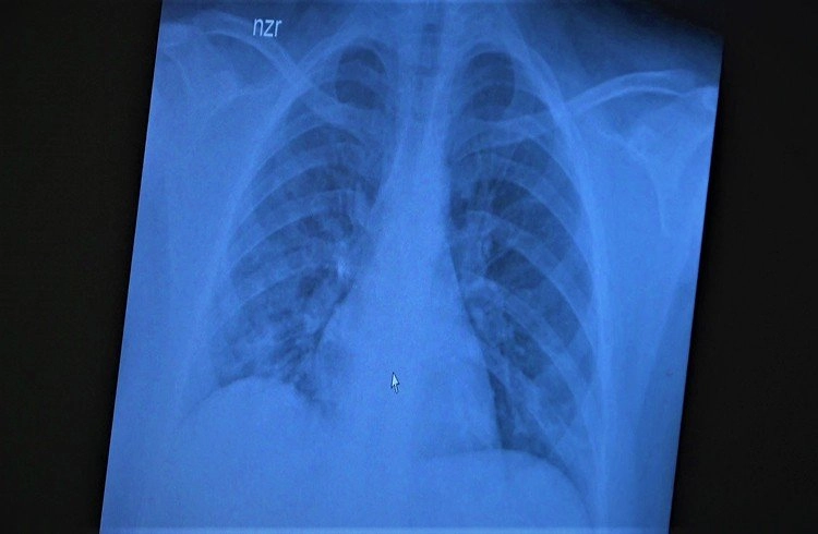 Koronaya yakalanan 15 yaş altı çocukların akciğerlerinde görülüyor Görseli